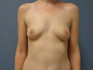 Breast Augmentation Before & After Pictures in Nashville, TN