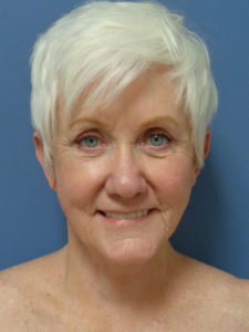 Facelift Before and After Pictures Nashville, TN