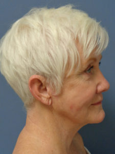 Facelift Before and After Pictures Nashville, TN