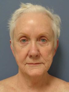 Facelift Before & After Pictures in Nashville, TN