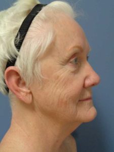 Facelift Before & After Pictures in Nashville, TN