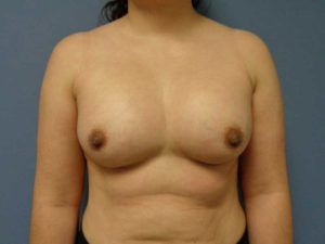 Before & After Pictures in Nashville, TN