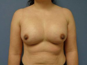 Breast Augmentation Before & After Pictures in Nashville, TN