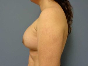 Breast Augmentation Before & After Pictures in Nashville, TN