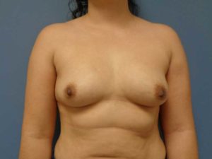 Breast Augmentation Before & After Pictures in Nashville, TN