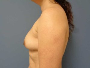 Breast Augmentation Before & After Pictures in Nashville, TN