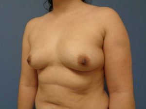 Before & After Pictures in Nashville, TN