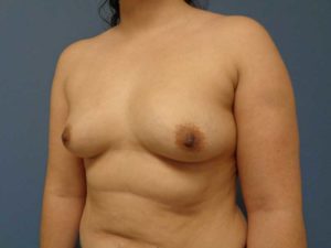 Breast Augmentation Before & After Pictures in Nashville, TN