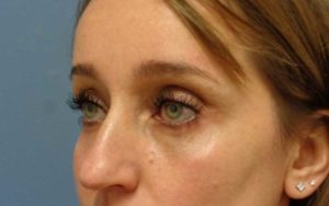 Blepharoplasty Before & After Pictures in Nashville, TN