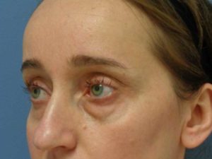 Blepharoplasty Before & After Pictures in Nashville, TN