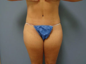 Tummy Tuck Before & After Pictures Nashville, TN