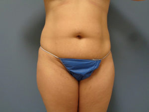 Tummy Tuck Before & After Pictures Nashville, TN