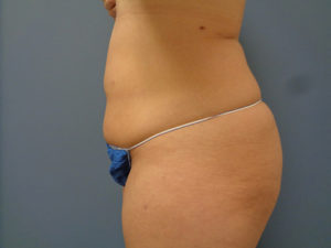 Tummy Tuck Before & After Pictures Nashville, TN