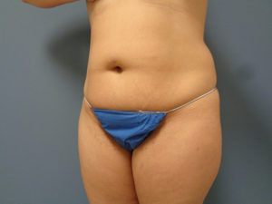 Tummy Tuck Before & After Pictures Nashville, TN