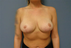 Breast Reduction Before & After Pictures Nashville, TN