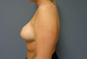 Breast Reduction Before & After Pictures Nashville, TN