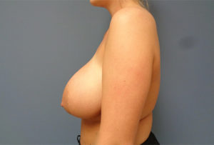 Breast Reduction Before & After Pictures Nashville, TN