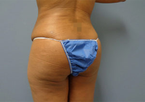 Butt Augmentation Before & After Pictures in Nashville, TN