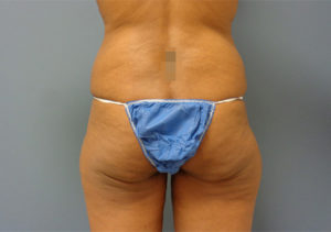 Butt Augmentation Before & After Pictures in Nashville, TN