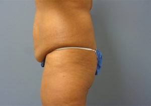 Butt Augmentation Before And After Pictures Nashville, TN