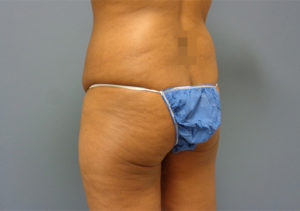 Butt Augmentation Before & After Pictures in Nashville, TN