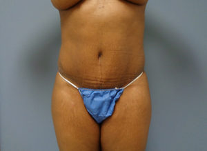 Tummy Tuck Before & After Pictures Nashville, TN