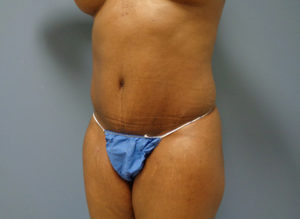 Tummy Tuck Before & After Pictures Nashville, TN