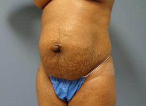 Tummy Tuck Before & After Pictures Nashville, TN