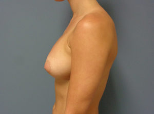 Breast Augmentation Before & After Pictures in Nashville, TN