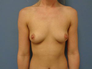 Breast Augmentation Before & After Pictures in Nashville, TN