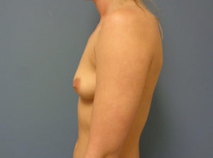 Breast Augmentation Before & After Pictures in Nashville, TN