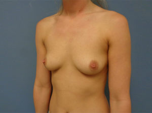 Breast Augmentation Before & After Pictures in Nashville, TN