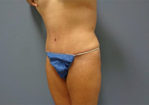 Tummy Tuck Before & After Pictures Nashville, TN