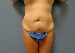 Tummy Tuck Before & After Pictures Nashville, TN