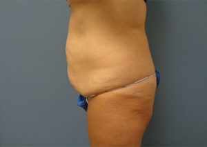 Tummy Tuck Before & After Pictures Nashville, TN