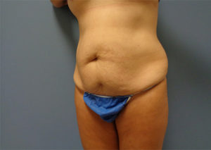 Tummy Tuck Before & After Pictures Nashville, TN