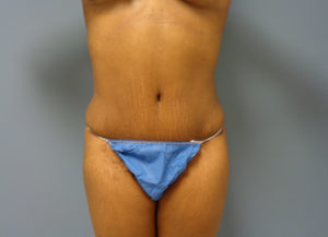 Tummy Tuck Before & After Pictures Nashville, TN