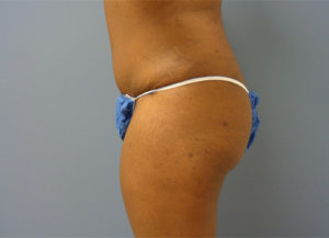 Butt Augmentation Before And After Pictures Nashville, TN