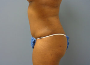 Tummy Tuck Before & After Pictures Nashville, TN