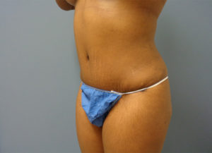 Tummy Tuck Before & After Pictures Nashville, TN