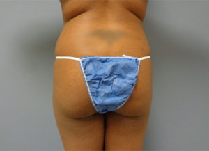 Butt Augmentation Before And After Pictures Nashville, TN