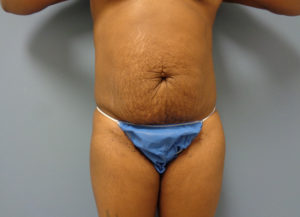 Tummy Tuck Before & After Pictures Nashville, TN