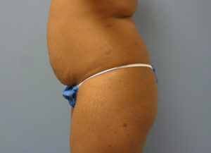 Butt Augmentation Before And After Pictures Nashville, TN