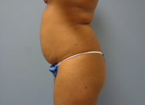 Tummy Tuck Before & After Pictures Nashville, TN