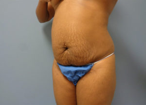 Tummy Tuck Before & After Pictures Nashville, TN