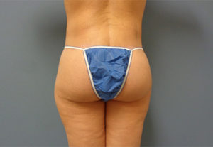 Butt Augmentation Before And After Pictures Nashville, TN