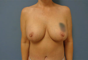 Breast Augmentation with Lift Before & After Pictures Nashville, TN