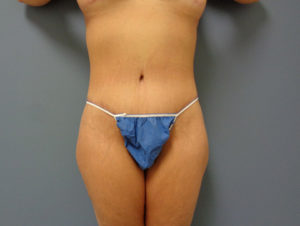 Tummy Tuck Before & After Pictures Nashville, TN