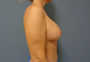 Breast Augmentation with Lift Before & After Pictures Nashville, TN