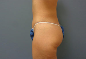 Butt Augmentation Before And After Pictures Nashville, TN